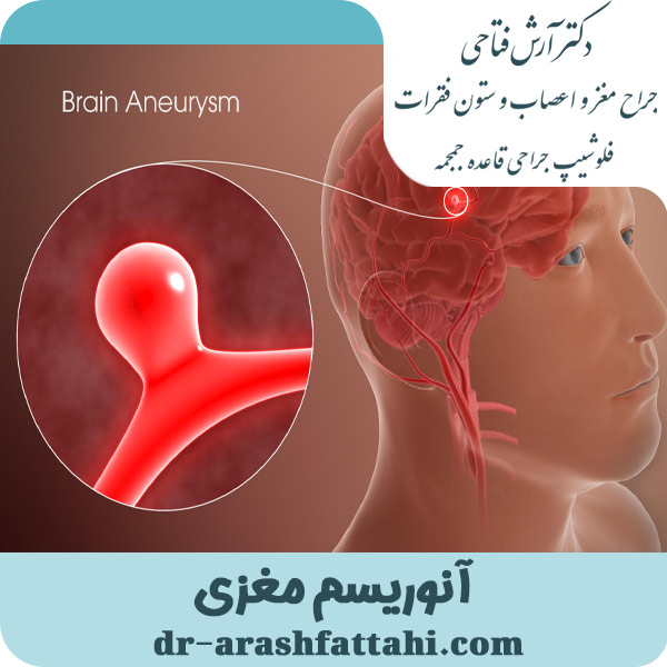 آنوریسم مغزی - دکتر آرش فتاحی -dr-arashfattahi.com