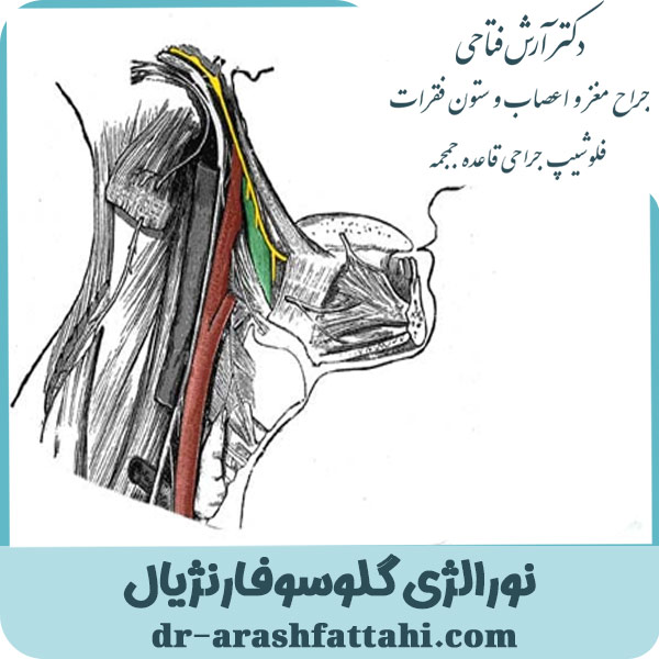 نورالژی گلوسوفارنژیال- دکتر آرش فتاحی - dr-arashfattahi.com