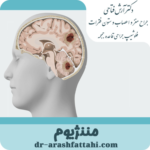 مننژیوم - دکتر آرش فتاحی- dr-arashfattahi.com