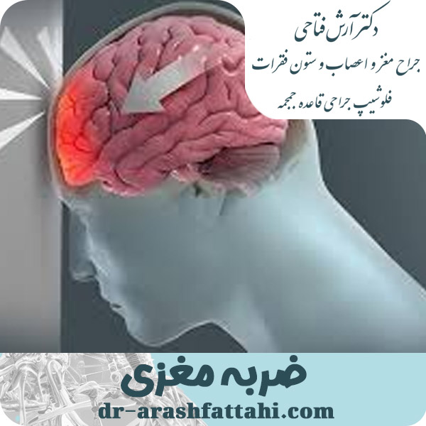 ضربه مغزی - دکتر آرش فتاحی - dr-arashfattahi.com