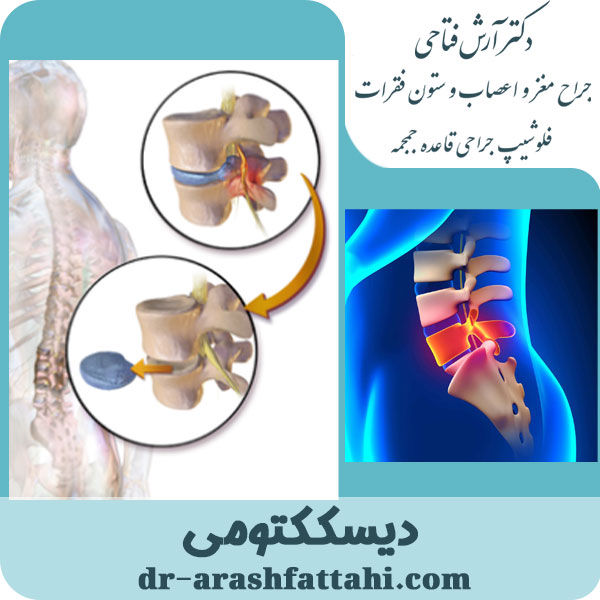 جراحی دیسک کمر و گردن - دکتر آرش فتاحی - dr-arashfattahi.com