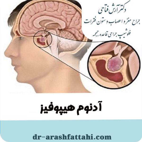آدنوم هیپوفیز - دکتر آرش فتاحی - dr-arashfattahi.com