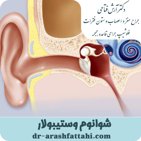 شوانوم وستیبولار - دکتر آرش فتاحی - dr-arashfattahi.com