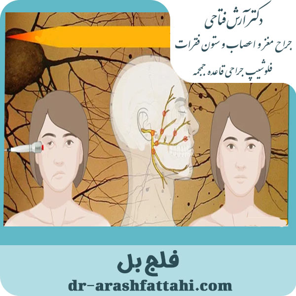 فلج بل - دکتر آرش فتاحی - dr-arashfattahi.com