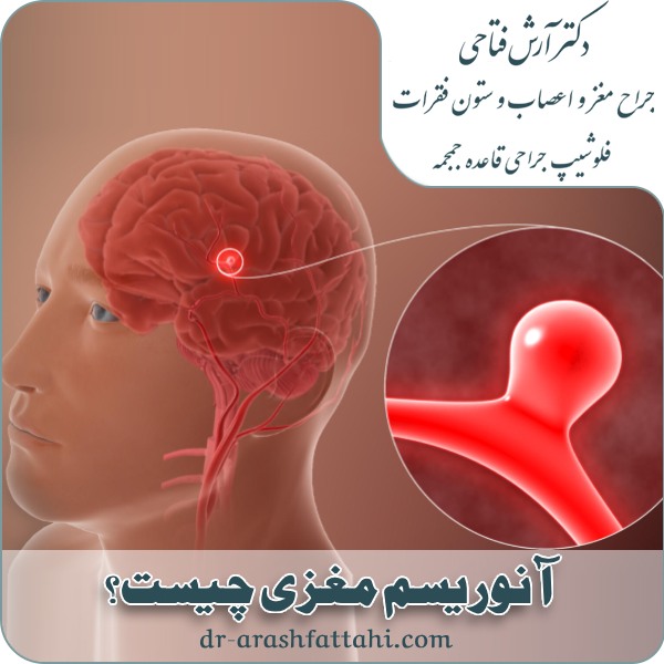آنوریسم مغزی