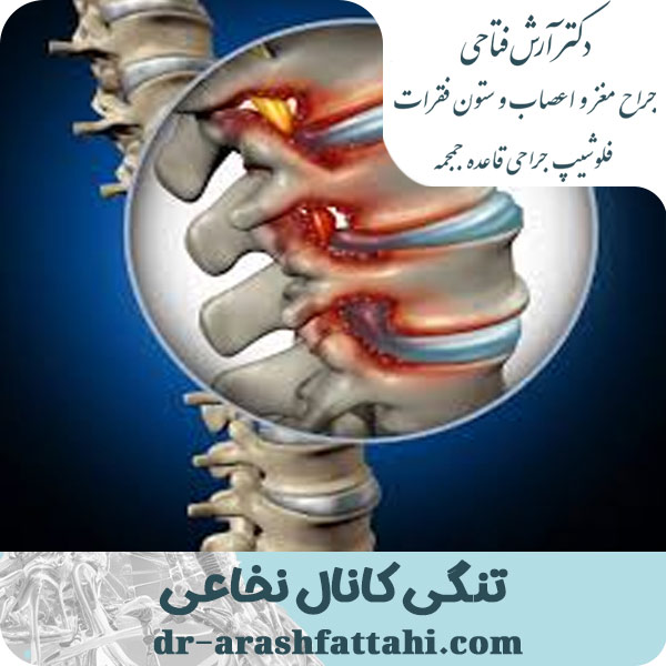 تنگی کانال نخاعی - دکتر آرش فتاحی - dr-arashfattahi.com