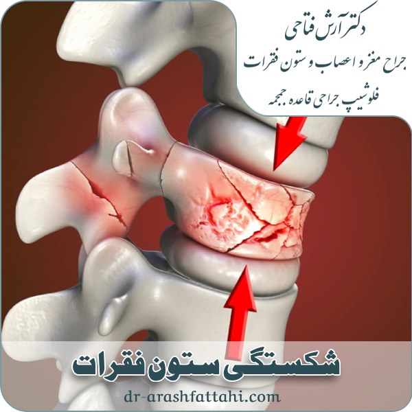شکستگی ستون فقرات