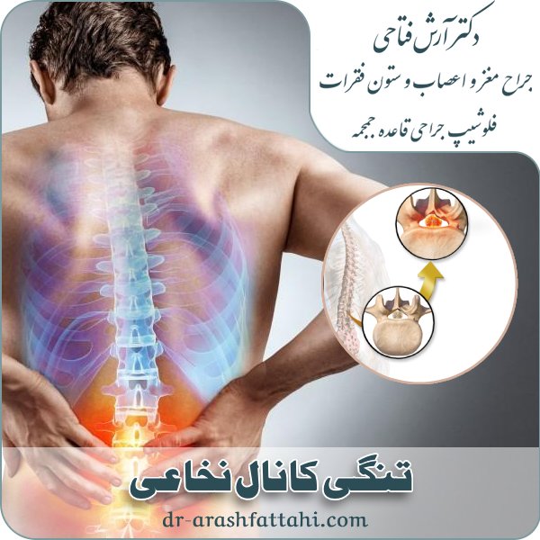 تنگی کانال نخاعی