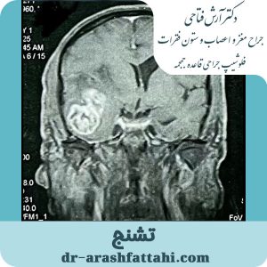تشنج- دکتر آرش فتاحی - dr-arashfattahi.com