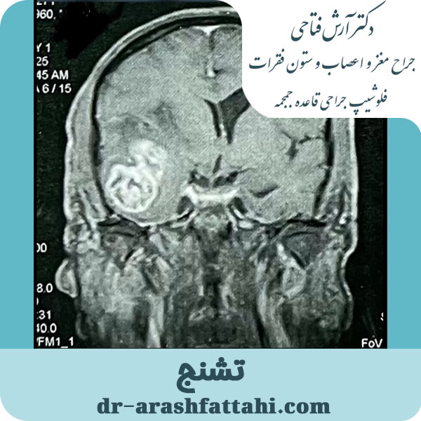 تشنج- دکتر آرش فتاحی - dr-arashfattahi.com