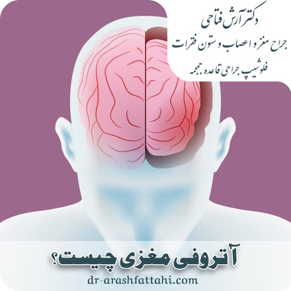 آتروفی مغزی