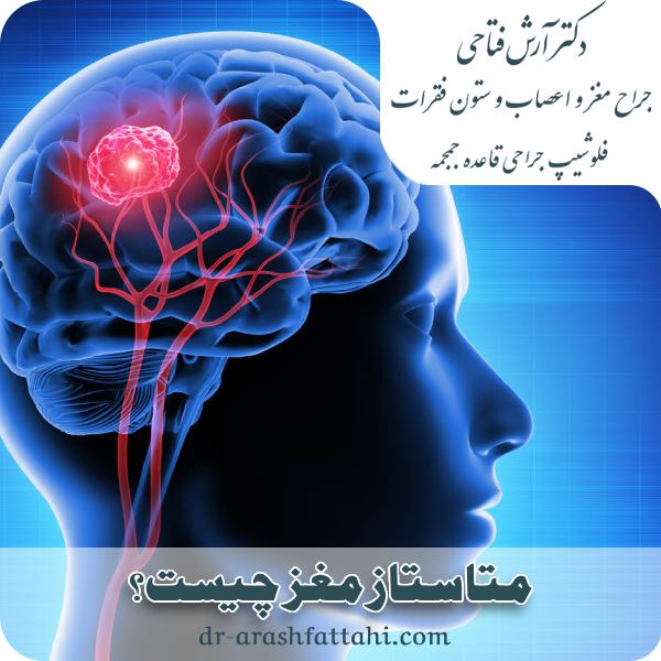 متاستاز مغز