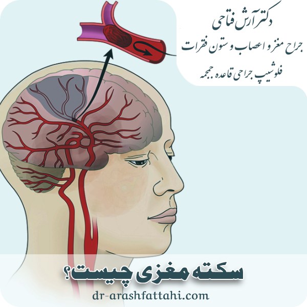 سکته مغزی
