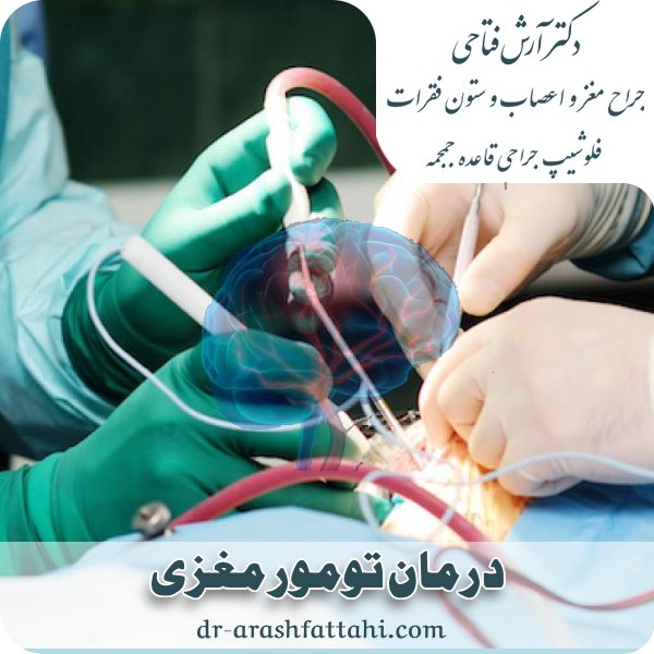 درمان تومور مغزی