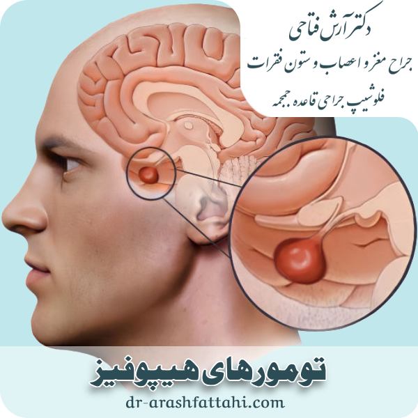تورمورهای هیپوفیز