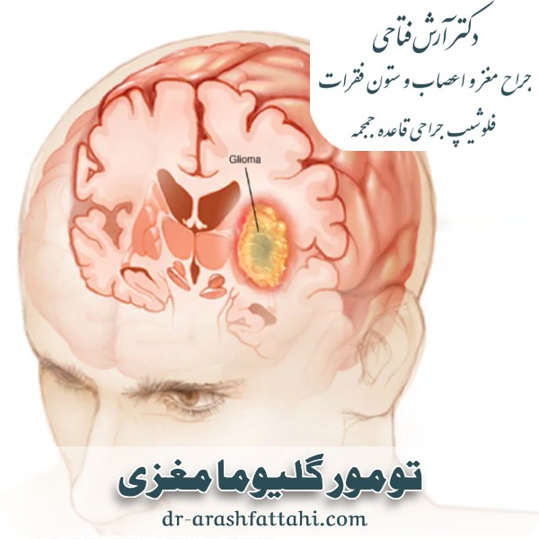 گلیوما مغزی