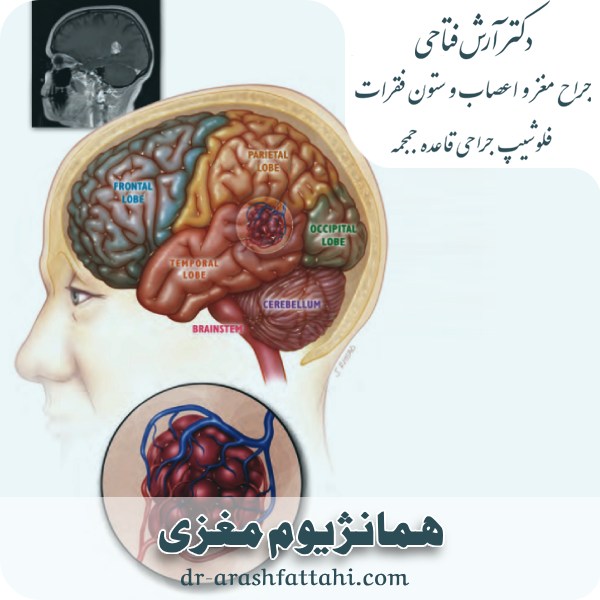 همانژیوم مغزی چیست