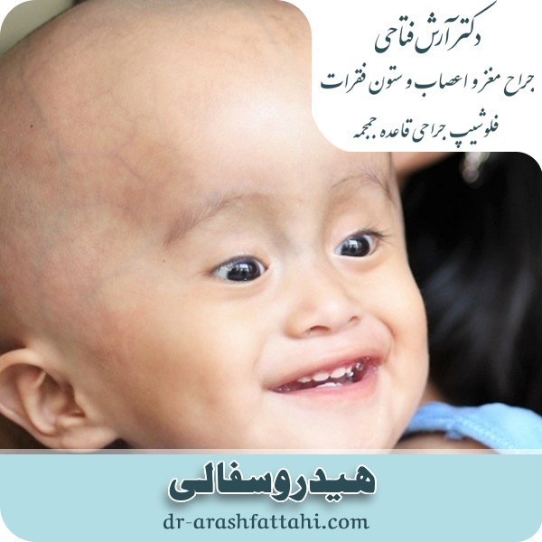 هیدروسفالی