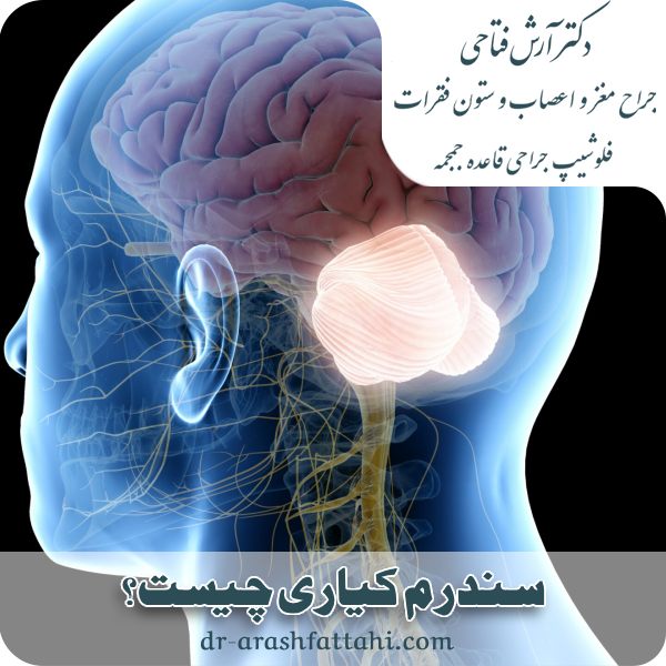 سندرم کیاری