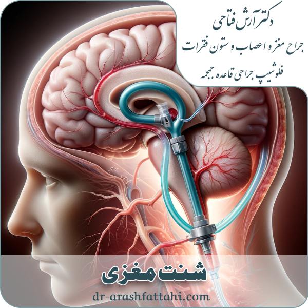 شنت مغزی