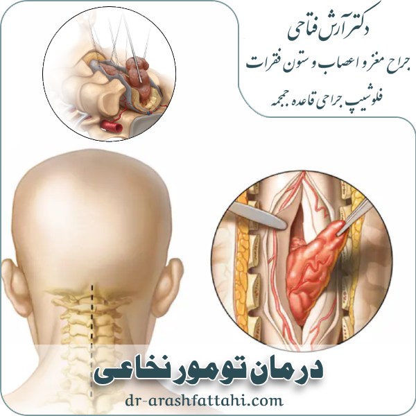 درمان تومور نخاعی