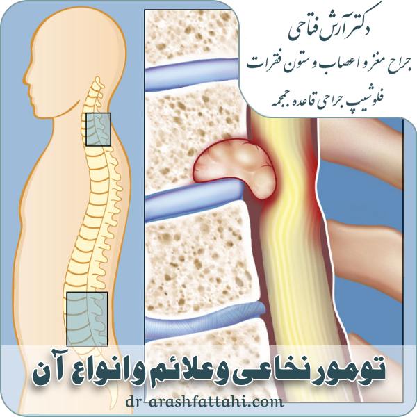 تومور نخاعی