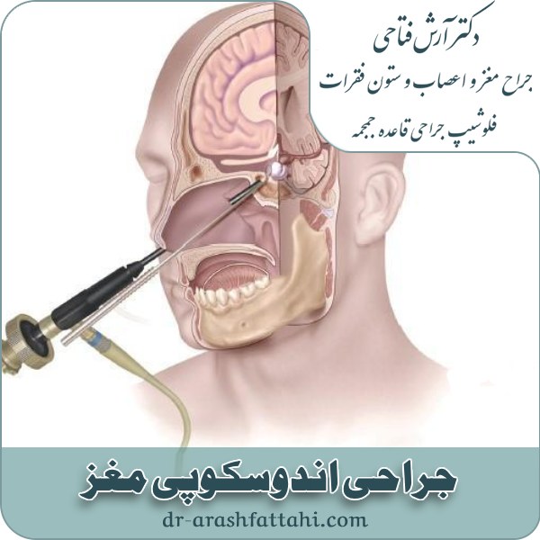 جراحی اندوسکوپی مغز