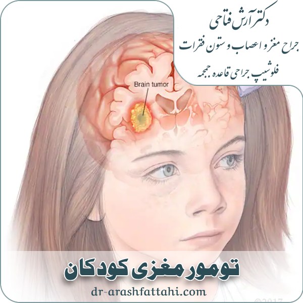 تومور مغزی کودکان