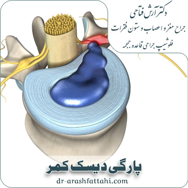 پارگی دیسک کمر
