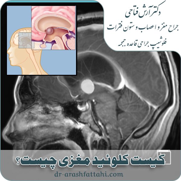 کیست کلوئید مغزی چیست