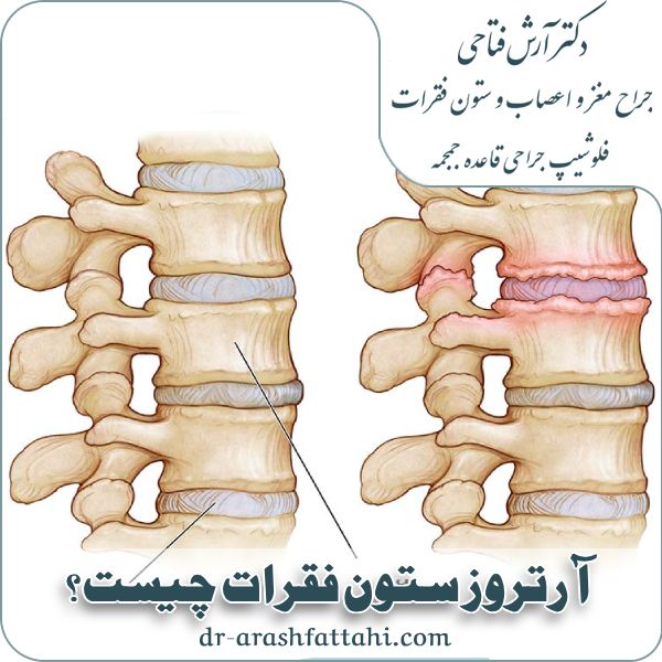 علت آرتروز ستون فقرات چیست؟ علائم و درمان آرتروز ستون فقرات