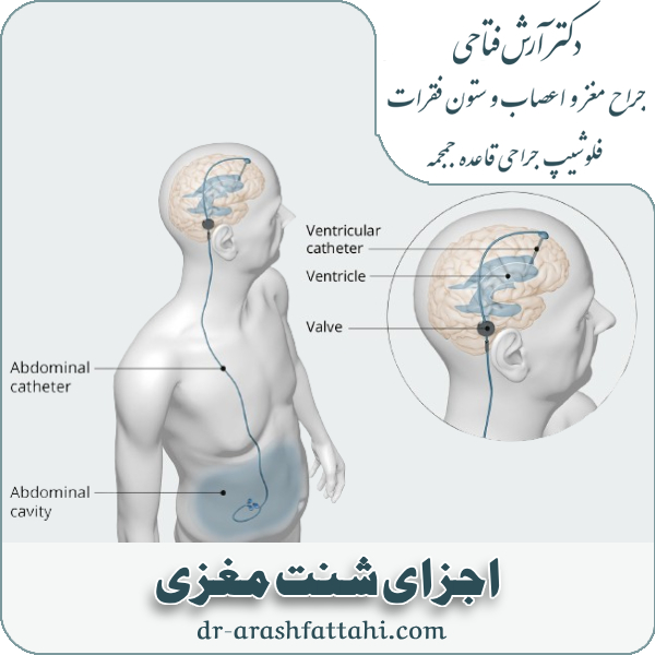 اجزای شنت مغزی