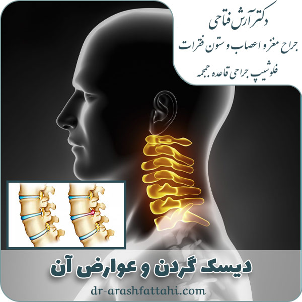 بیماری دیسک گردن چیست؟ دلایل و عوارض دیسک گردن