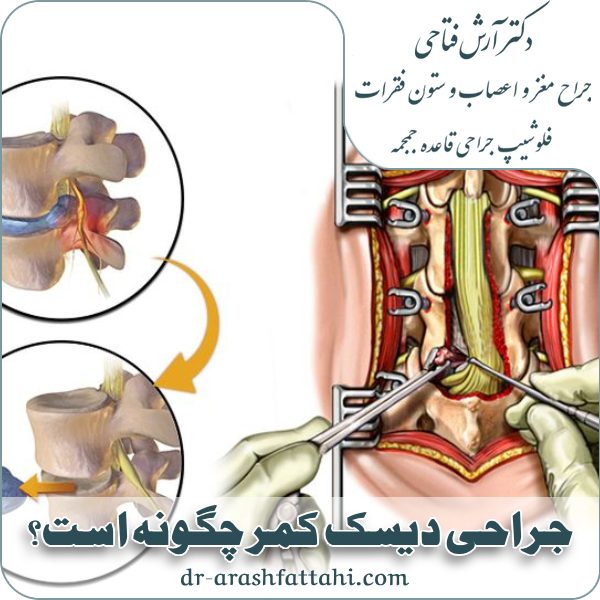 جراحی دیسک کمر چگونه است؟ انواع تکنیک های جراحی دیسک کمر