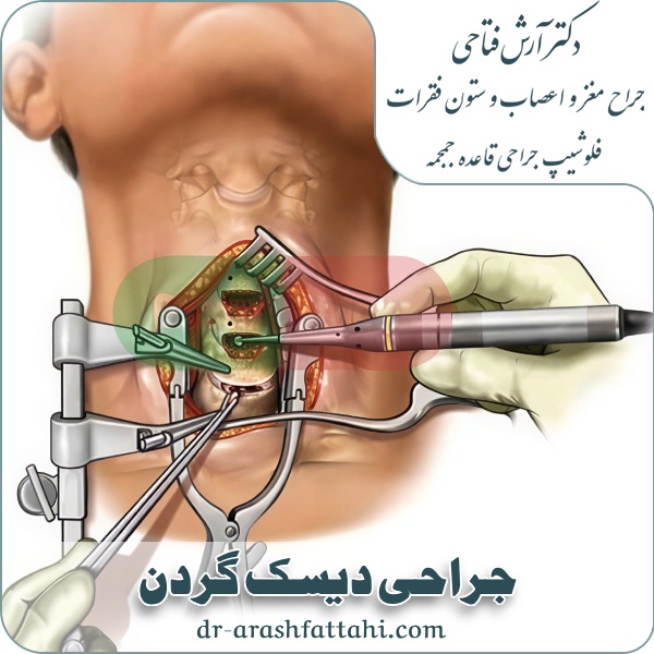 جراحی دیسک گردن