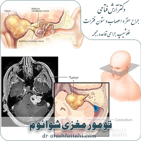 تومور مغزی شوانوم چیست؟انواع و علائم شوانوما